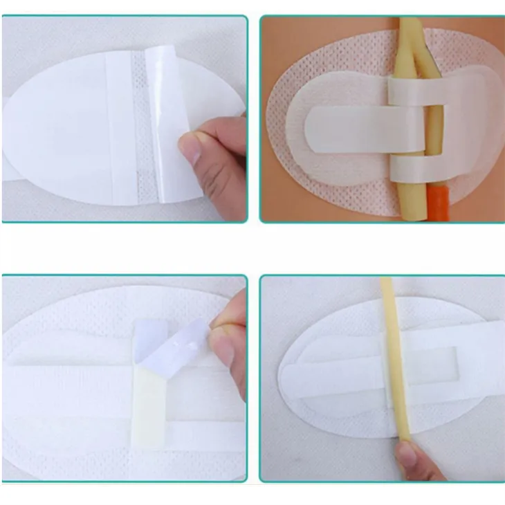 Urinary Catheter Securement Dressing